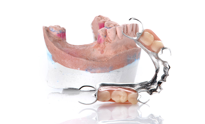Pose de prothèse dentaire partielle amovible dans Lanaudière - Denturologiste Sylvain Perreault à Joliette