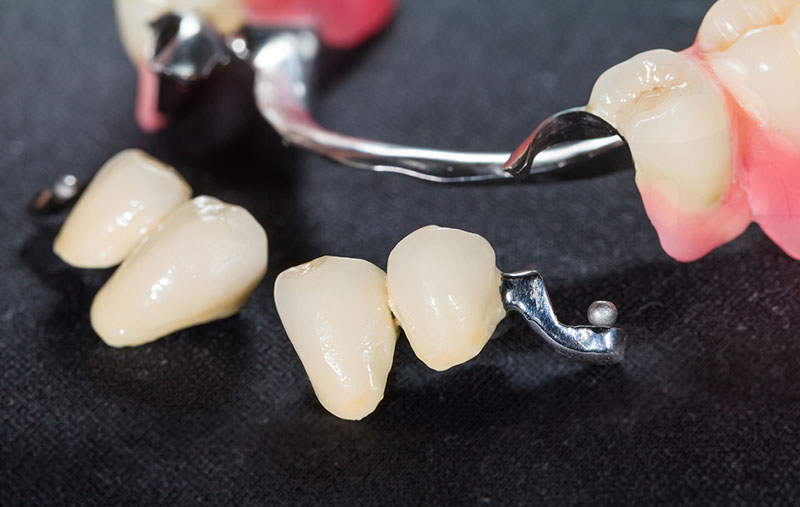 Pose de prothèse dentaire partielle amovible à Joliette et ses environs - Denturologiste Sylvain Perreault à Joliette