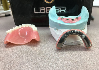 Pose de prothèse dentaire sur implant dans Lanaudière - Denturologiste Sylvain Perreault à Joliette