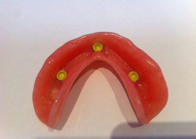 Pose d'implant dentaire à Berthierville - Denturologiste Sylvain Perreault à Joliette