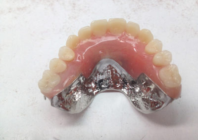 Pose d'implant dentaire à Joliette - Denturologiste Sylvain Perreault à Joliette