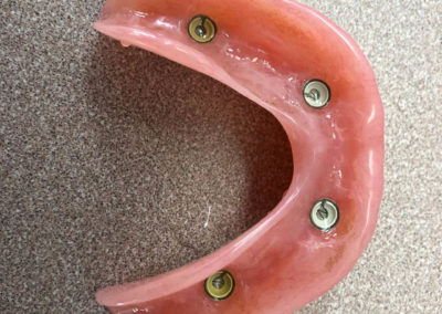 Pose d'implant dentaire dans Lanaudière - Denturologiste Sylvain Perreault à Joliette