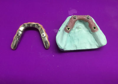 Prothèse dentaire sur implant à Joliette - Denturologiste Sylvain Perreault à Joliette