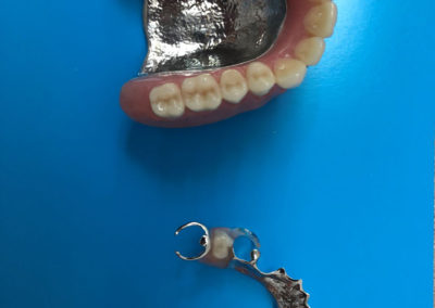 Regarnissage de prothèse dentaire à Joliette - Denturologiste Sylvain Perreault à Joliette